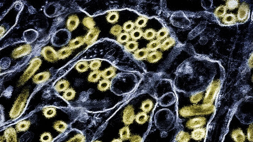 Suspected human bird flu case may be 1st in US in 9 months