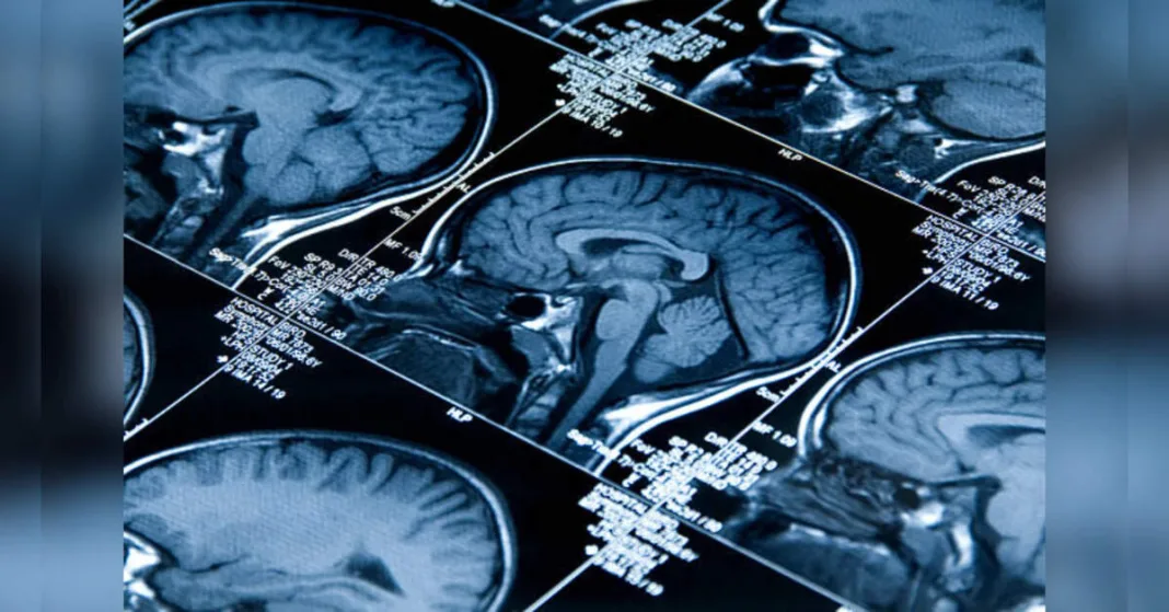 Brain disorders associated with increased brain ageing: Study, ETHealthworld