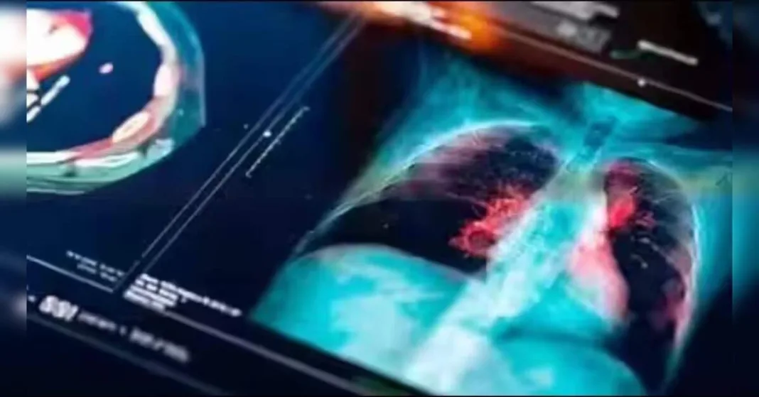 Global lung cancer screening lessons offer roadmap for India: AIIMS expert, ETHealthworld